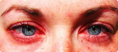 allergia-szem.jpg